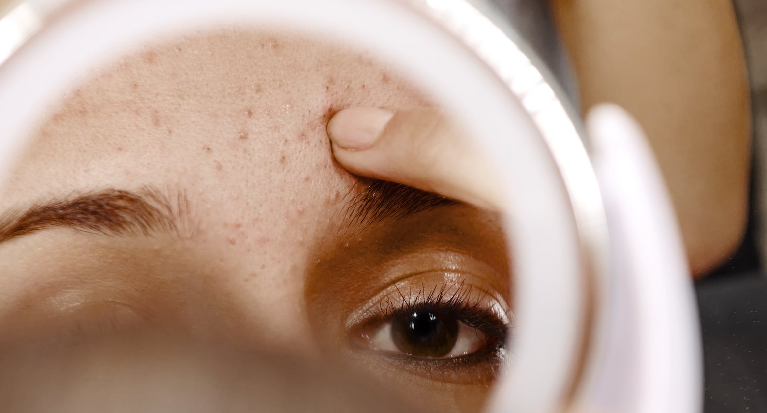 The different types of acne