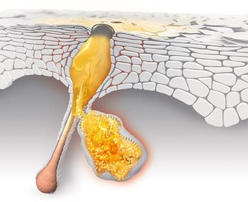 Diagram of a blackhead