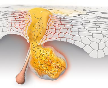 P.acnes bacteria causes acne to develop and spread