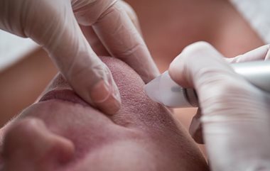 Acne scar removal