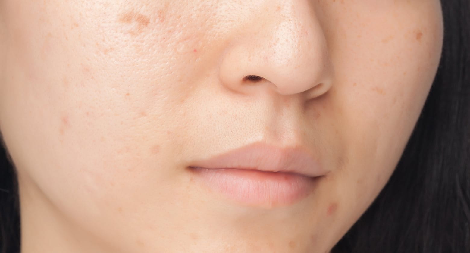 Acne and hyperpigmentation