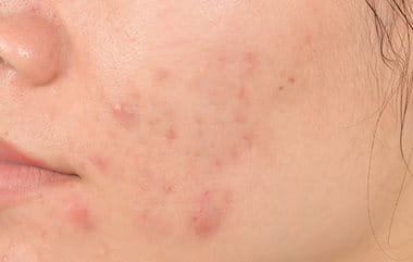 Pimple marks causes by acne