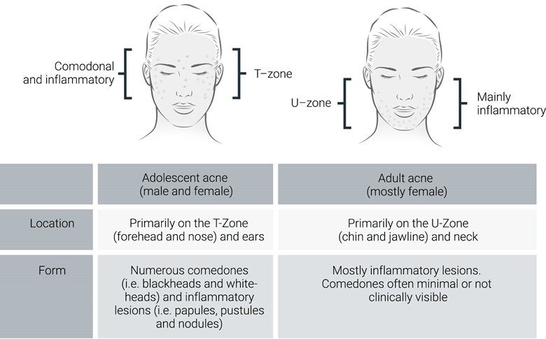 How acne differs according to age