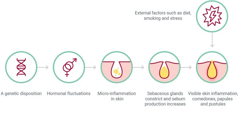 How do the pimples, papules and pustules of adult acne develop?