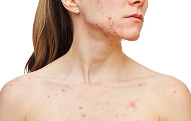Acne in 30s on the chin