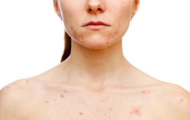 Blemishes on the face and décolleté