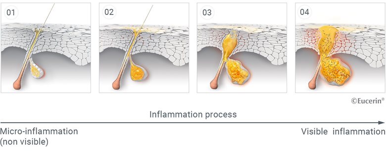 How blemishes and acne develop