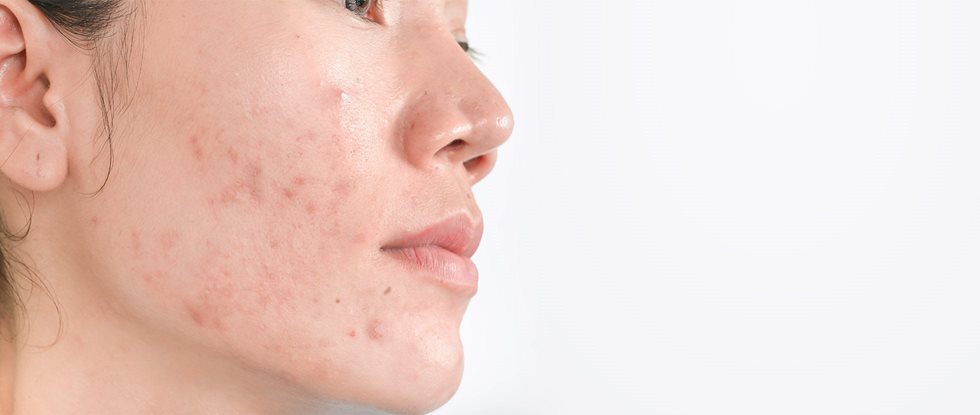 Post-inflammatory hyperpigmentation from acne