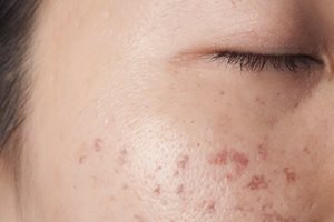 post-inflammatory hyperpigmentation (PIH) on cheek