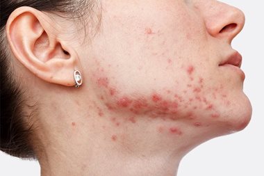 Hyperpigmentation from acne