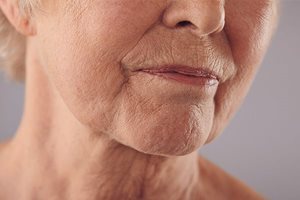 Sensitive skin and the sun: aging skin