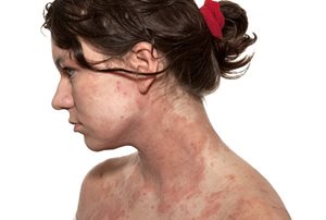 Sun protection for reactive skin