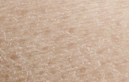 Close-up from dry skin