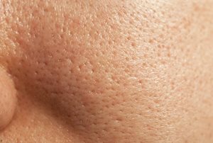 Oily skin needs appropriate sun protection