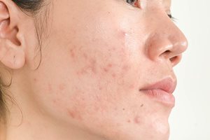 Acne scars and sun damage: hyperpigmentation