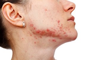 Acne and sun exposure