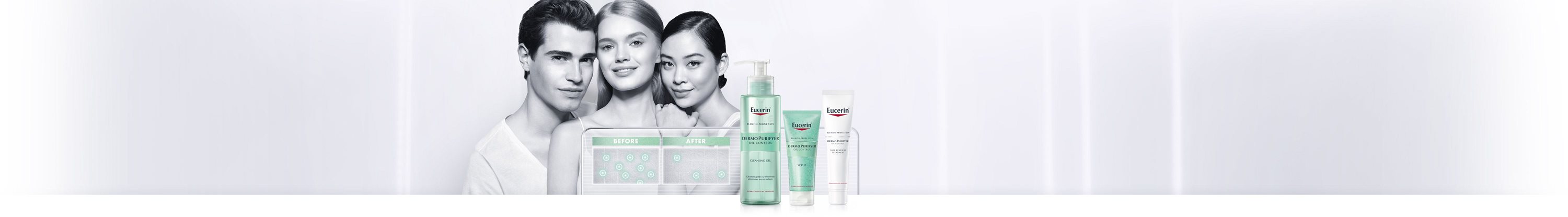 Woman with facial acne prone skin 