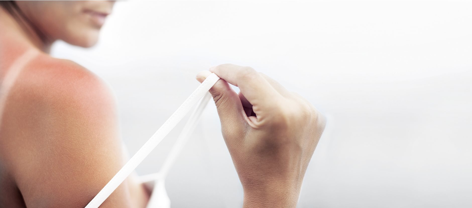 Skincare for minor burns